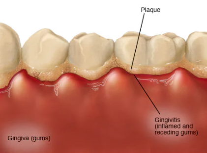 Gingivitis